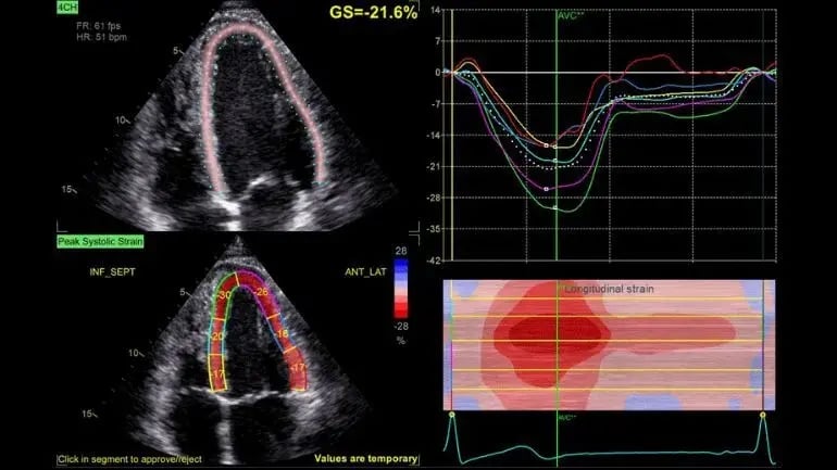 Ecocardiograma con análisis de deformación miocárdica y gráficos cardiacos