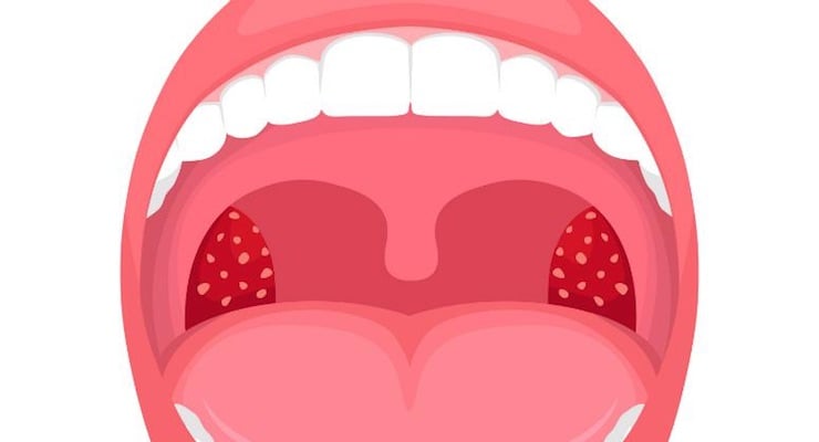 Ilustración médica de una boca abierta que muestra las amígdalas inflamadas y enrojecidas con puntos blancos, representando un cuadro de amigdalitis.