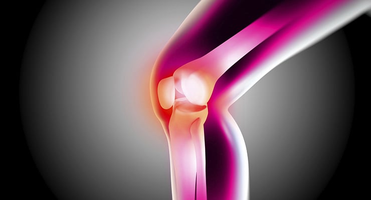 Ilustración de una articulación de la rodilla con zonas resaltadas que muestran inflamación y desgaste articular.