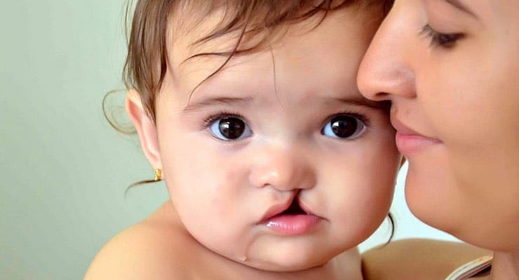 Bebé con labio leporino en brazos de una mujer, con el rostro en primer plano.