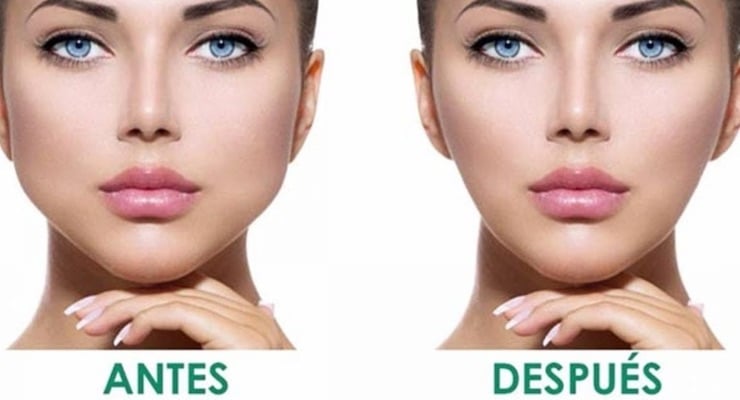 Comparación antes y después del rostro de una mujer tras procedimiento estético de bichectomía