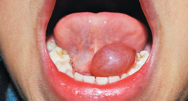 Interior de la boca con la lengua levantada y una protuberancia visible en la parte inferior