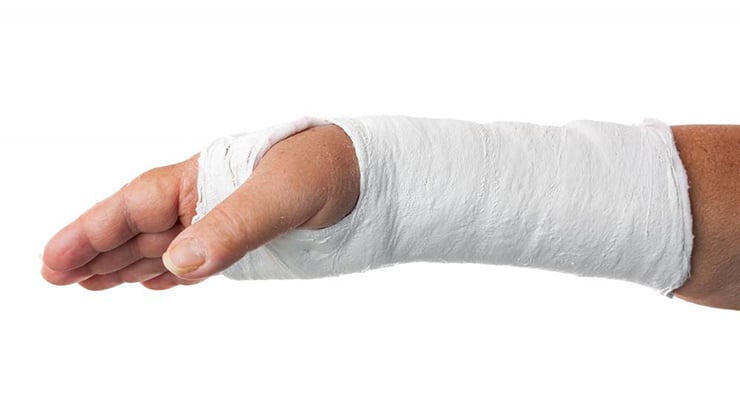 Brazo de una persona con un yeso blanco que cubre la mano y el antebrazo