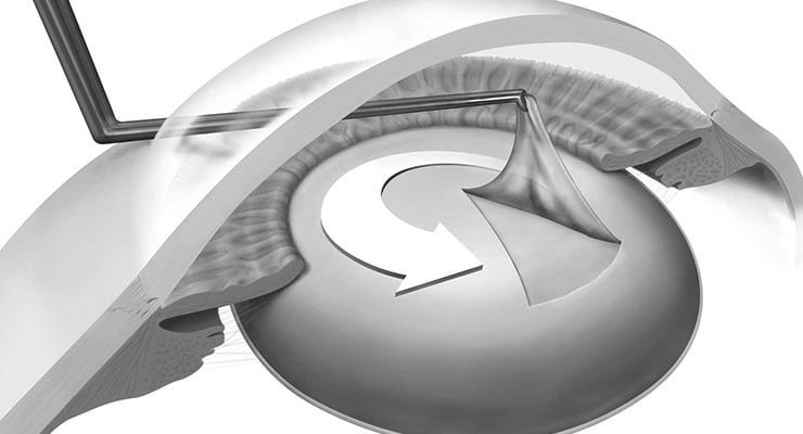 Ilustración médica del ojo humano que muestra el cristalino afectado por catarata y el procedimiento quirúrgico.