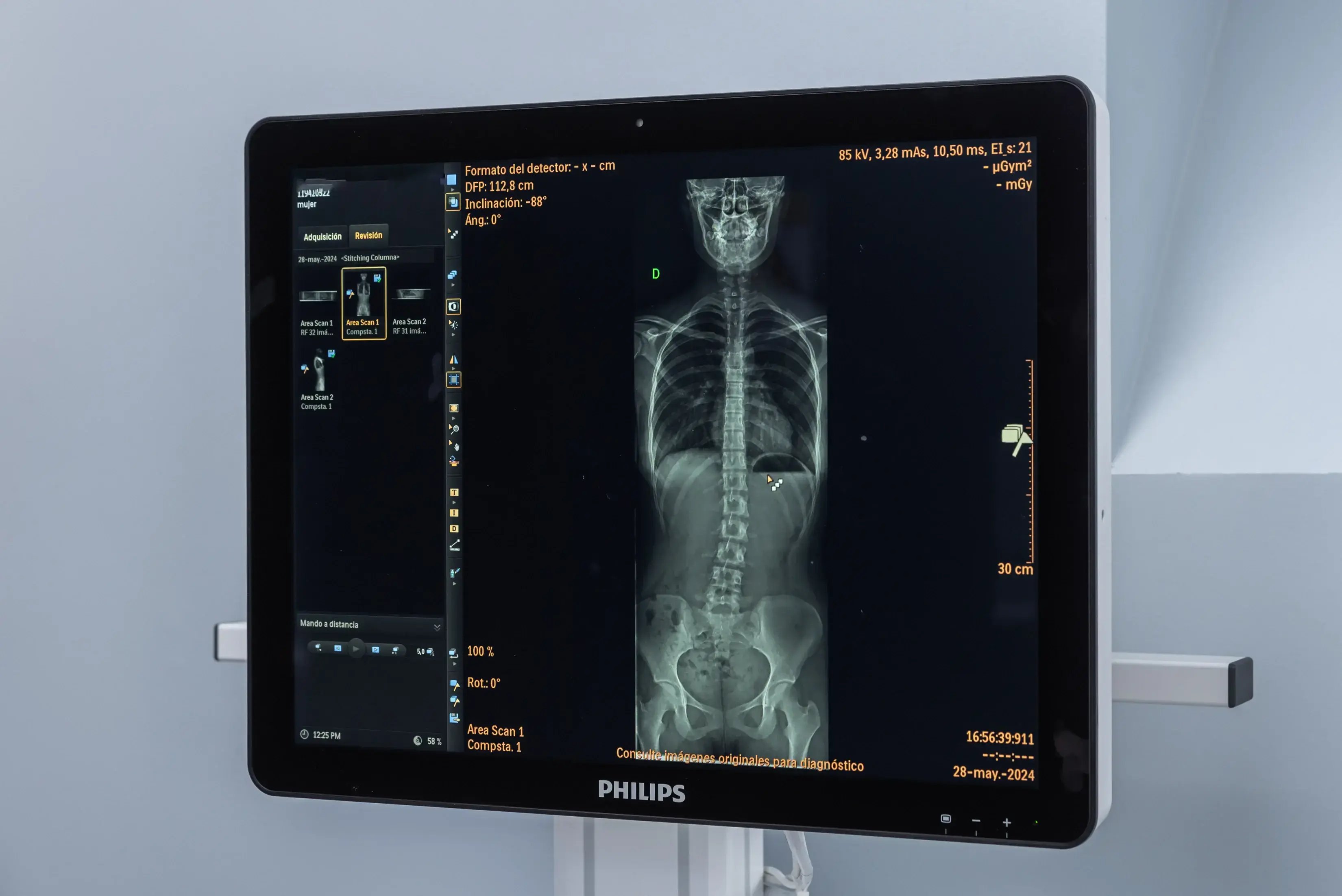Digital X-ray of spine displayed on medical monitor at Clínica Bíblica
