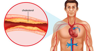 Ilustración médica de acumulación de colesterol en una arteria junto a esquema del sistema circulatorio masculino
