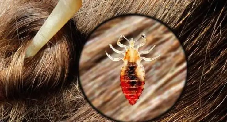 Imagen compuesta que muestra un mechón de cabello castaño y un círculo ampliado con la vista microscópica de un piojo, ilustrando una infestación capilar.