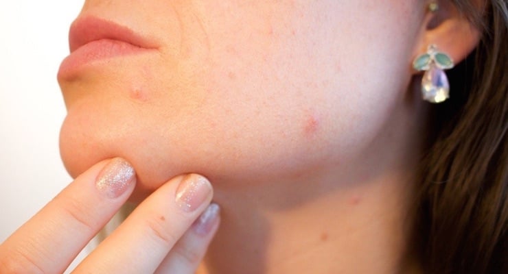 Primer plano del rostro y cuello de una mujer mostrando pequeñas manchas rojizas y cicatrices leves en la piel, características de las secuelas de la varicela.
