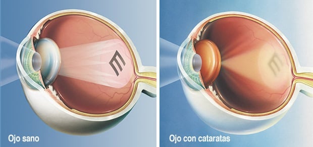 Ilustración comparativa de ojo sano y ojo con catarata mostrando visión nublada