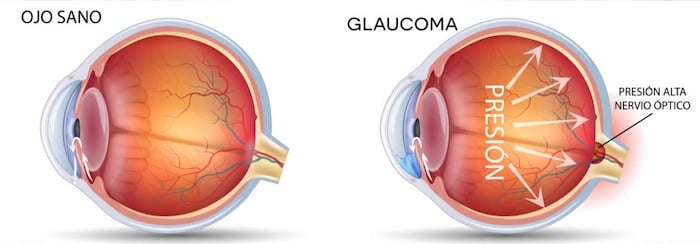 Ilustración comparativa de ojo sano y ojo con glaucoma mostrando aumento de presión en el nervio óptico