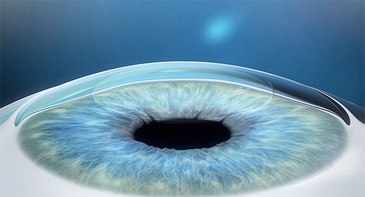 Primer plano de la córnea de un ojo humano con lente de contacto transparente.