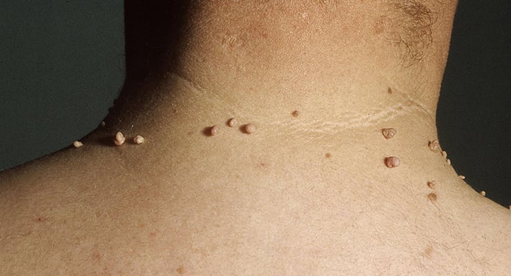 Parte posterior del cuello de una persona con múltiples protuberancias pequeñas en la piel