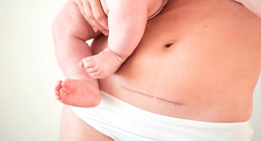 Primer plano del abdomen de una mujer con una cicatriz de cesárea reciente mientras sostiene a su bebé en brazos.