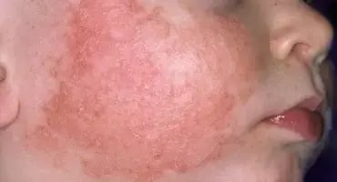 Mejilla de un niño con enrojecimiento y erupción cutánea visible.