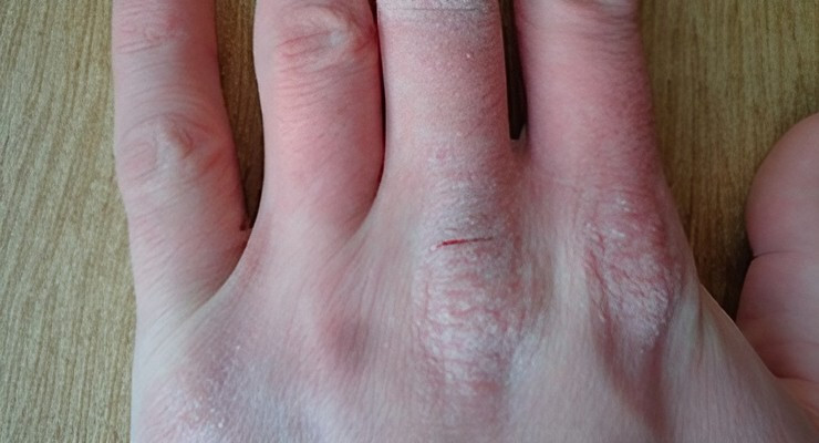 Enrojecimiento y resequedad en la piel de la mano con signos de dermatitis