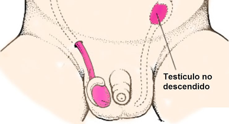 Ilustración médica del desarrollo testicular que muestra un testículo no descendido en la región inguinal.