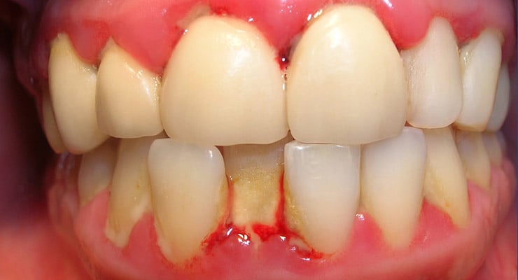 Primer plano de dientes con encías enrojecidas y sangrado visible