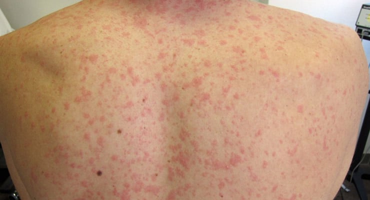 Espalda de una persona con erupción cutánea rojiza distribuida en la piel