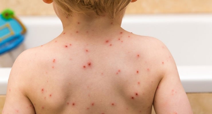 Espalda de un niño con erupciones cutáneas características de la varicela