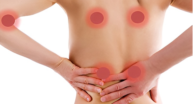 Persona con puntos de dolor marcados en espalda y brazos asociados a fibromialgia