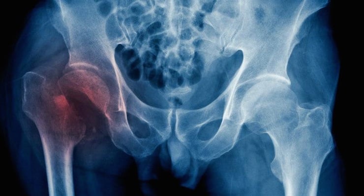Radiografía de pelvis con fractura de cadera resaltada