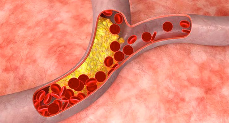 Ilustración médica de arteria con acumulación de grasa y glóbulos rojos circulando en el interior.