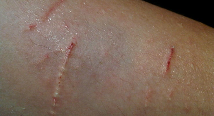 Primer plano de piel con heridas superficiales lineales visibles