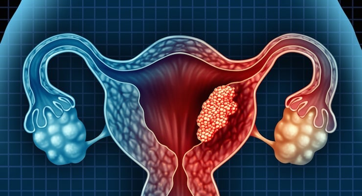 Ilustración médica del útero y ovarios con representación de un fibroma en el interior