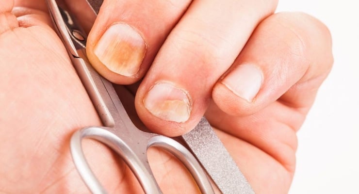 Primer plano de una mano sosteniendo unas tijeras de manicura, mostrando uñas con manchas amarillentas y signos de infección por hongos.