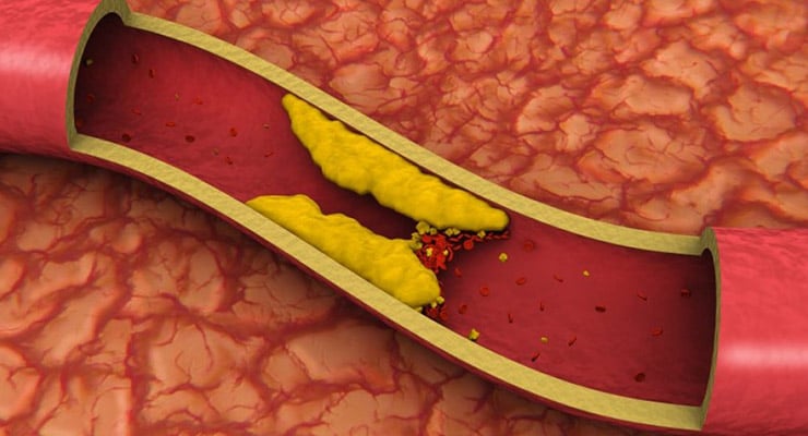 Ilustración médica del interior de una arteria con acumulación de placa