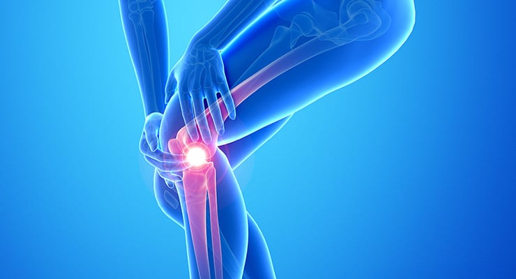 Ilustración médica de la articulación de la rodilla con una zona resaltada que indica lesión