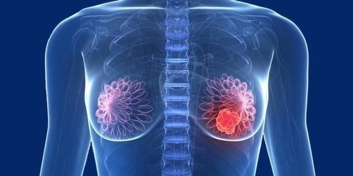 Ilustración médica del torso femenino con representación de los senos y una zona resaltada en uno de ellos