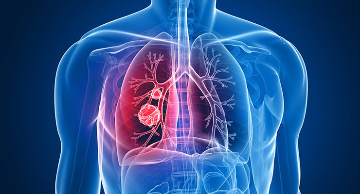 Ilustración médica del torso humano con un pulmón resaltado en color rojo.