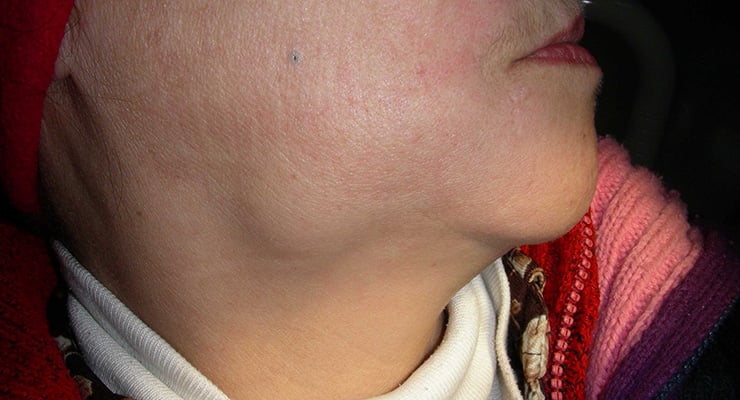 Cuello de una persona con inflamación visible en la zona lateral bajo la mandíbula.