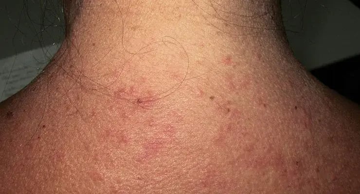 Irritación cutánea con pequeñas lesiones rojas en la parte posterior del cuello