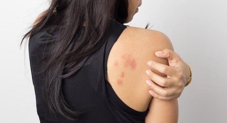Mujer de espaldas mostrando un brote cutáneo con manchas rojas en el hombro, una manifestación dermatológica asociada al COVID-19.