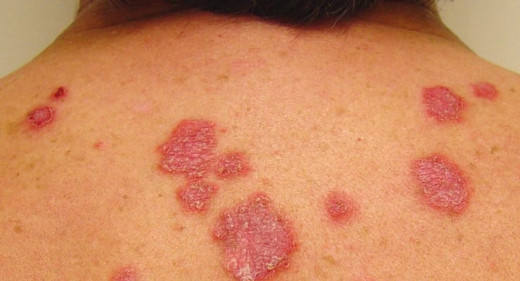 Espalda de una persona con múltiples lesiones circulares rojizas visibles en la piel