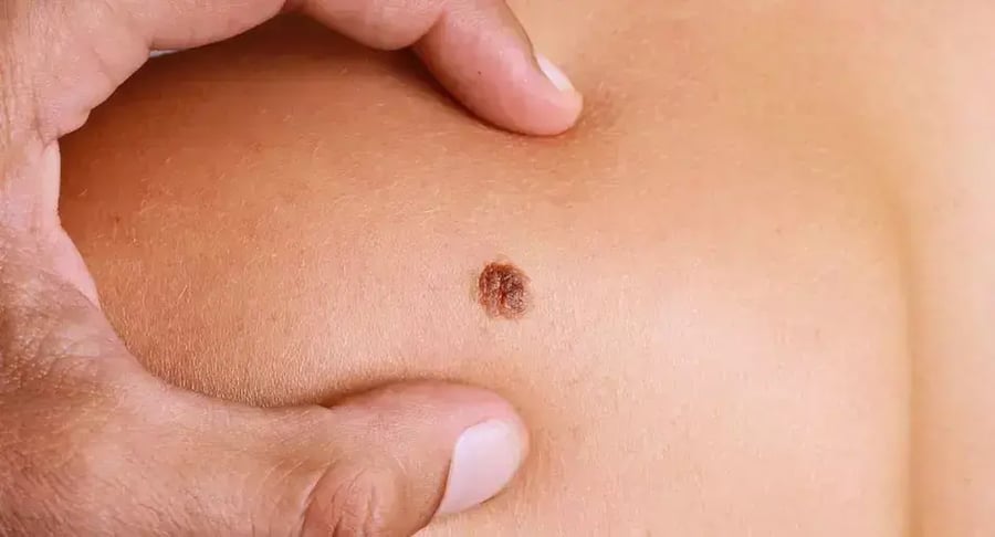 Lunar oscuro en la piel del pecho examinado por un especialista dermatológico