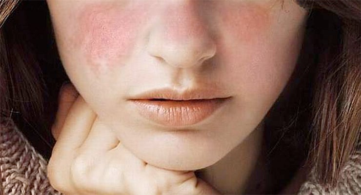 Rostro de mujer con enrojecimiento visible en las mejillas.