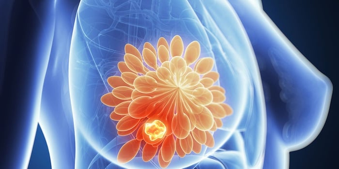 Ilustración médica de mama con tumor resaltado en tejido mamario para detección de cáncer