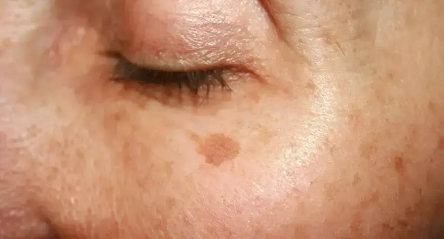 Mancha en la piel del rostro cerca del ojo como signo de hiperpigmentación