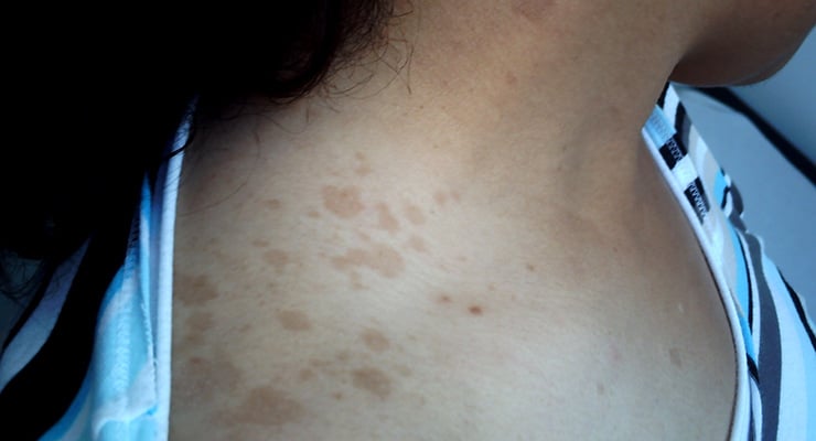 Piel del cuello y pecho con manchas claras visibles