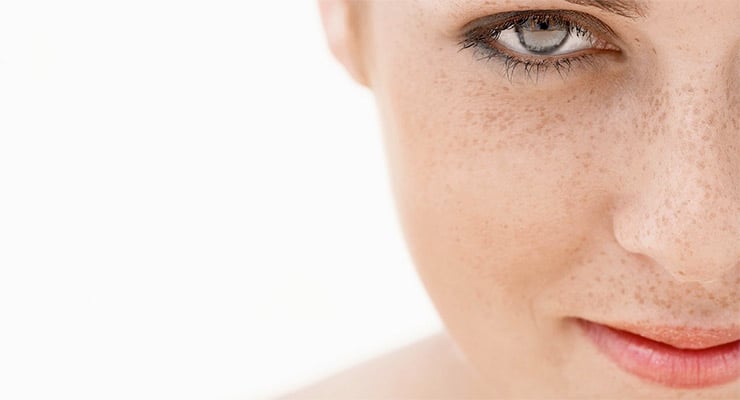 Primer plano del rostro de una mujer con pecas y manchas visibles en la piel del rostro.