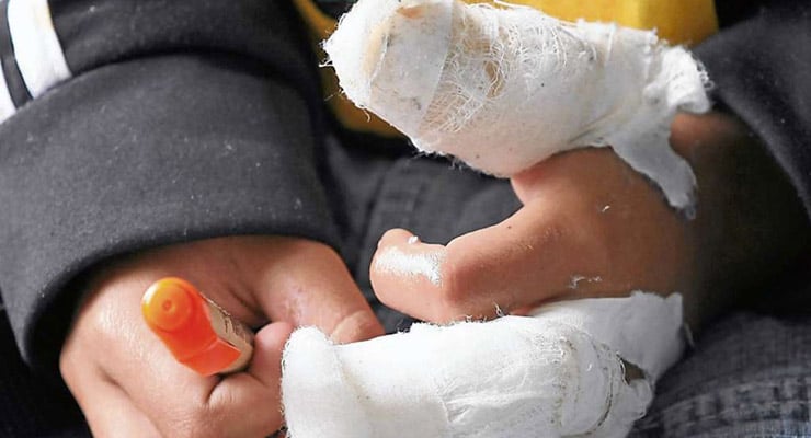 Manos de un niño con vendajes blancos cubriendo dedos y muñecas