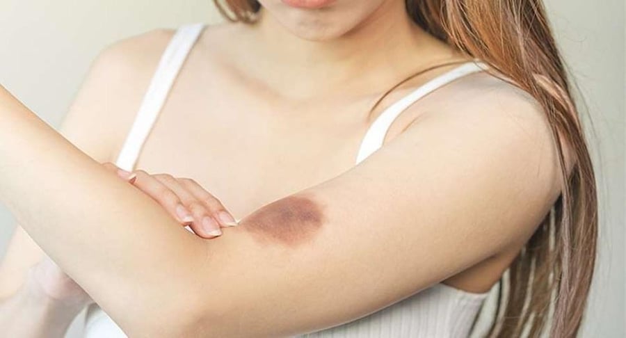 Primer plano de una mujer joven revisando con preocupación un moretón oscuro de forma circular en la parte interna de su antebrazo.