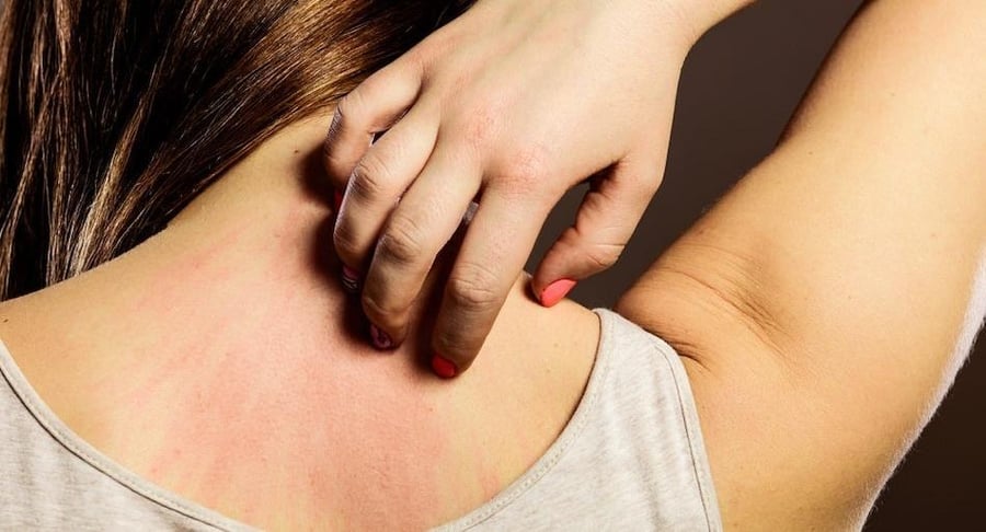 Primer plano de una mujer rascándose la parte superior de la espalda, mostrando una zona de la piel con enrojecimiento e irritación por eccema.