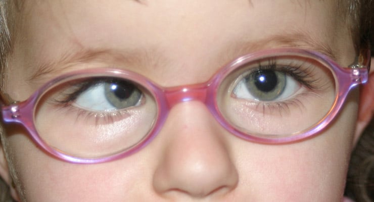 Primer plano del rostro de una niña usando lentes de color rosa y ambliopía