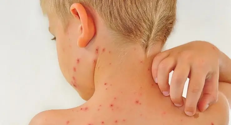 Niño con erupciones rojas en la espalda rascándose la piel.