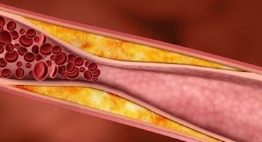 Ilustración médica de una arteria seccionada que muestra la acumulación de placa de grasa (colesterol) bloqueando el flujo de glóbulos rojos.