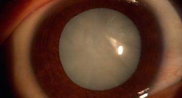 Primer plano de ojo con opacidad blanca en el cristalino causada por catarata